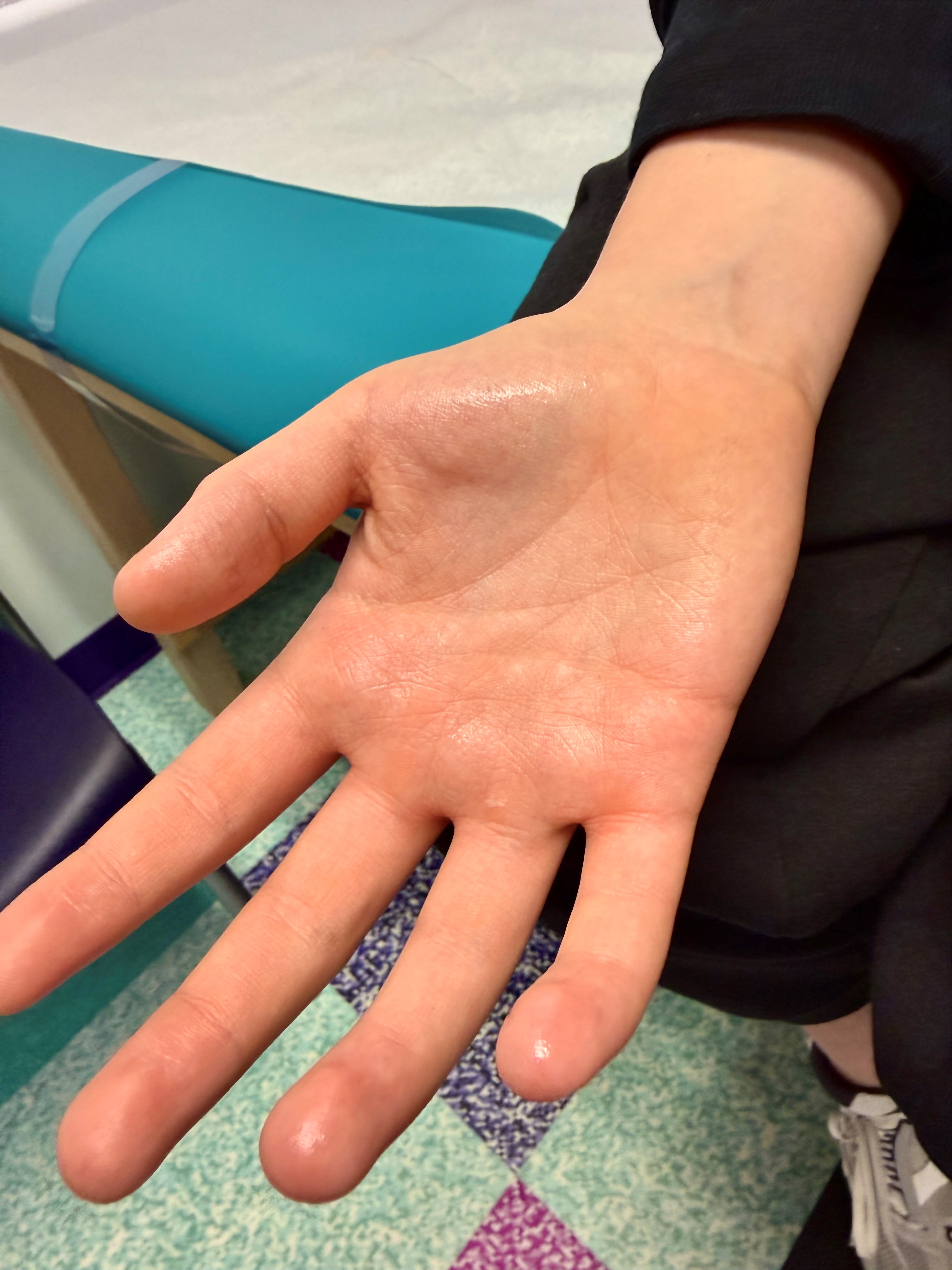 Visibly sweaty palm and extended fingers of a person's hand, suggesting hyperhidrosis. A blue surface and patterned floor in background