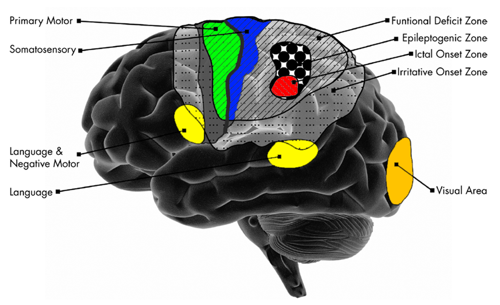 Epilepsy-Figure-1
