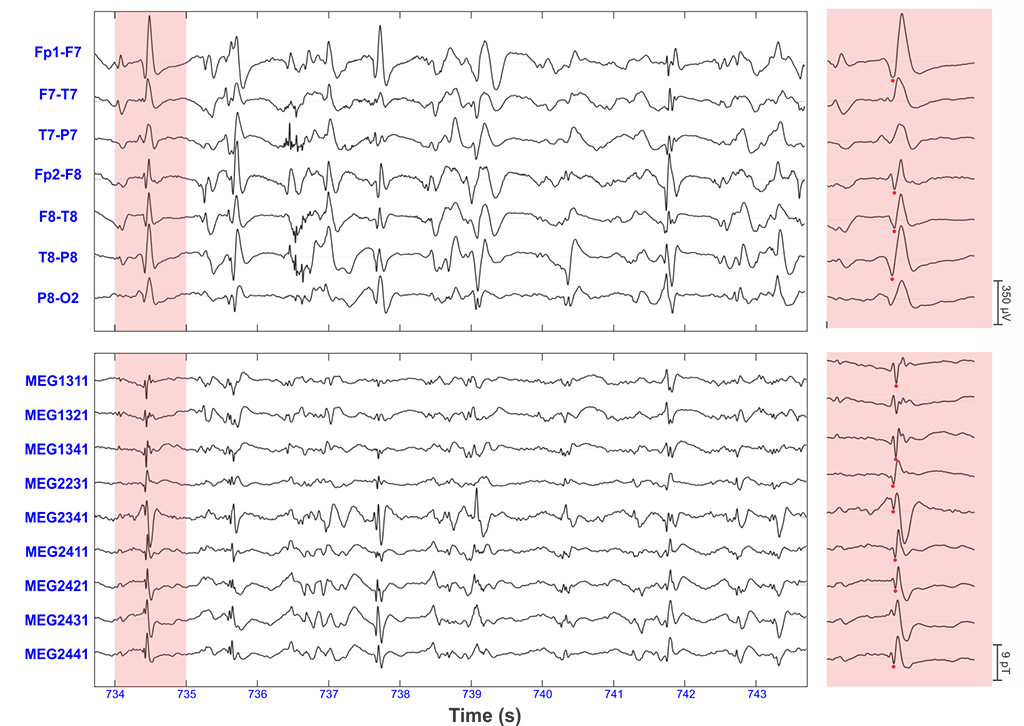 Epilepsy-Figure-2