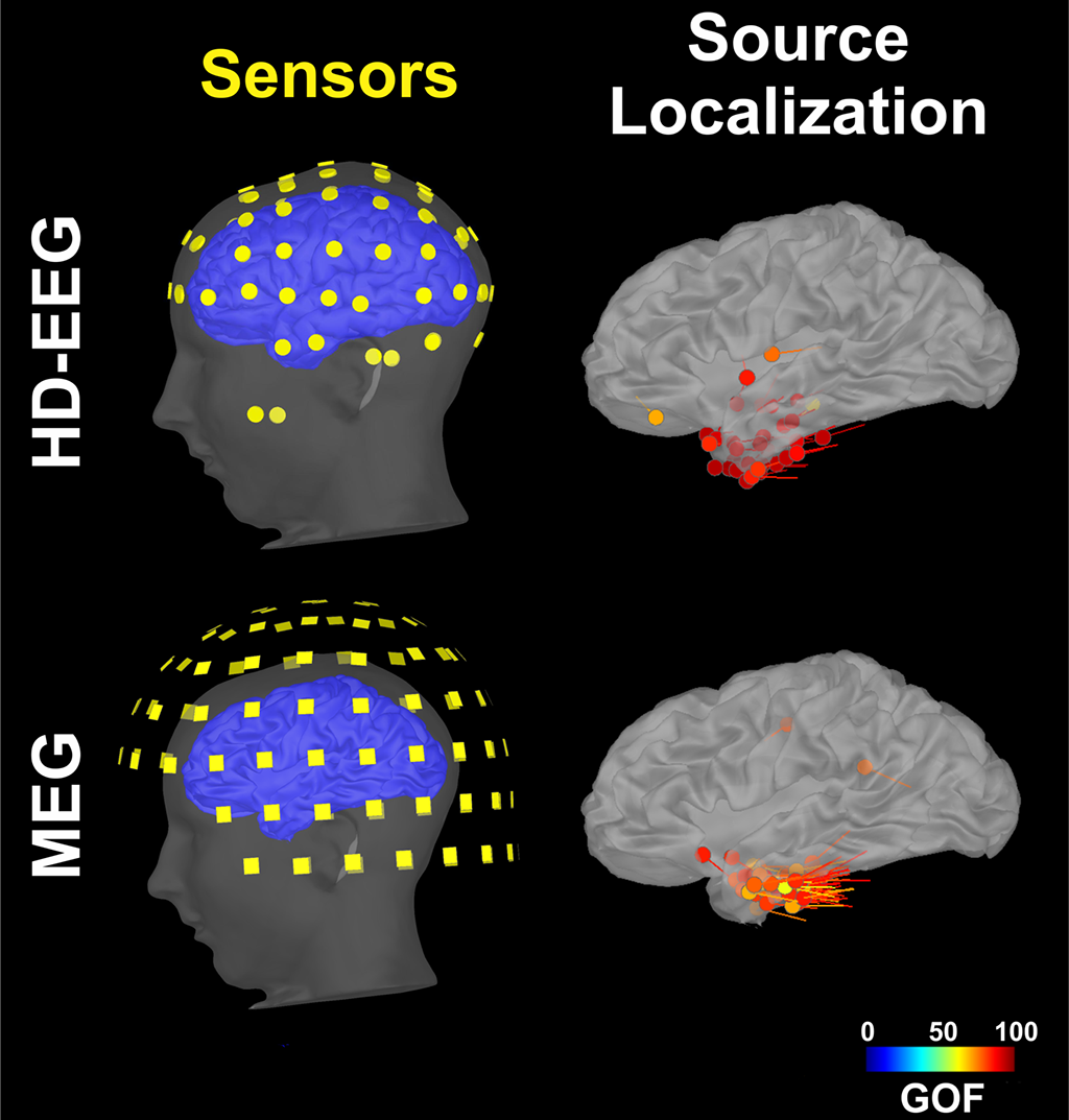 Epilepsy-Figure-3