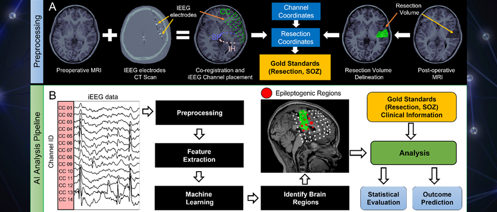 Workflow for epilepsy diagnosis: A) Imaging preprocessing for surgical planning. B) AI analysis of iEEG to find epileptogenic regions