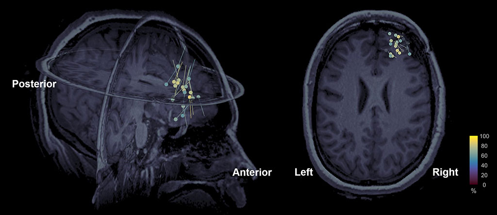 HD-EEG-fig2