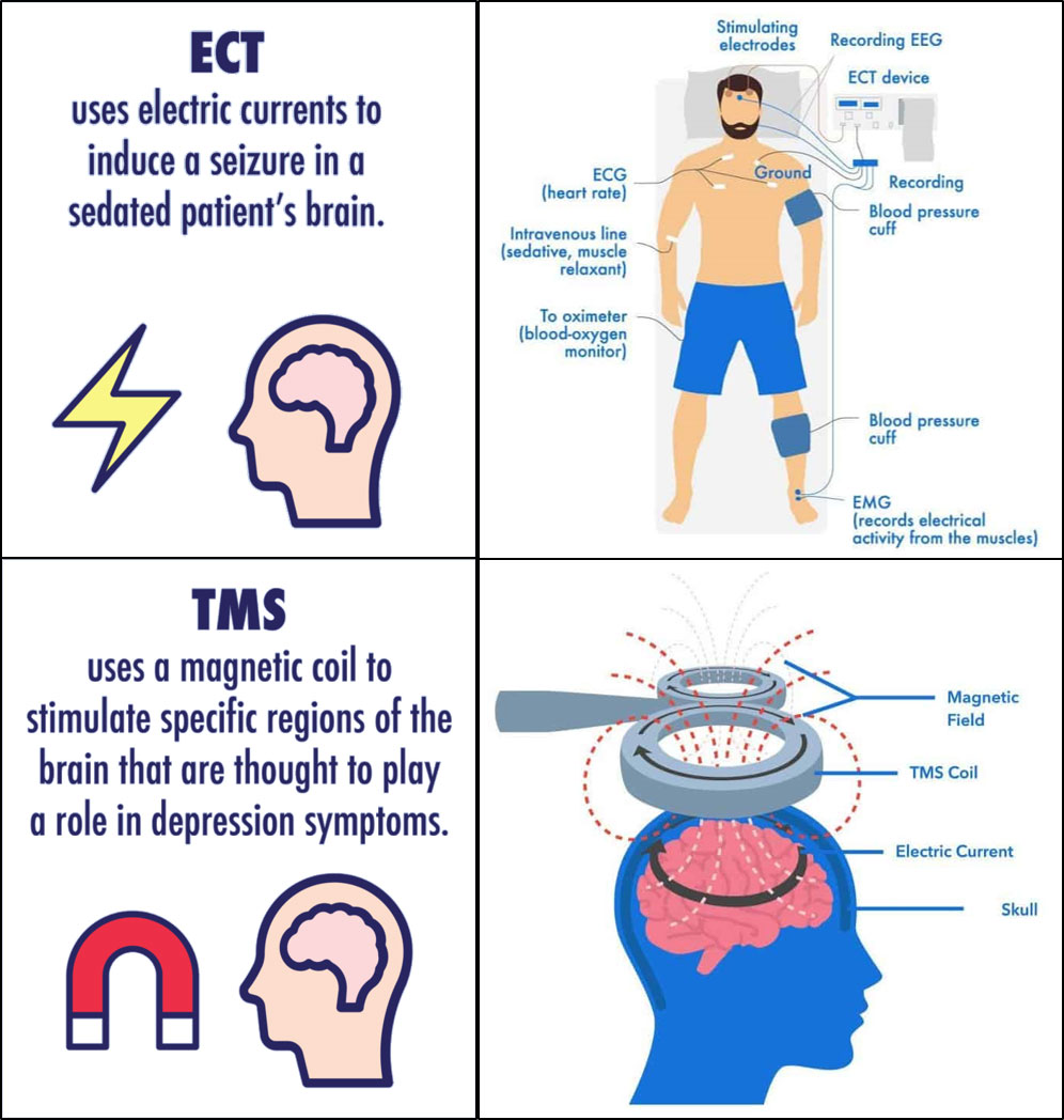 TMS-Figure-4---TMS