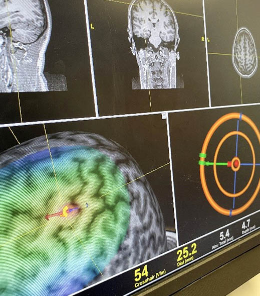 Medical screen shows brain MRI images, a 3D brain map with heat overlay, and a targeting system display