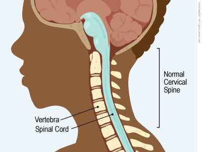 cervicalKyphosisEstab_400x300_enIL