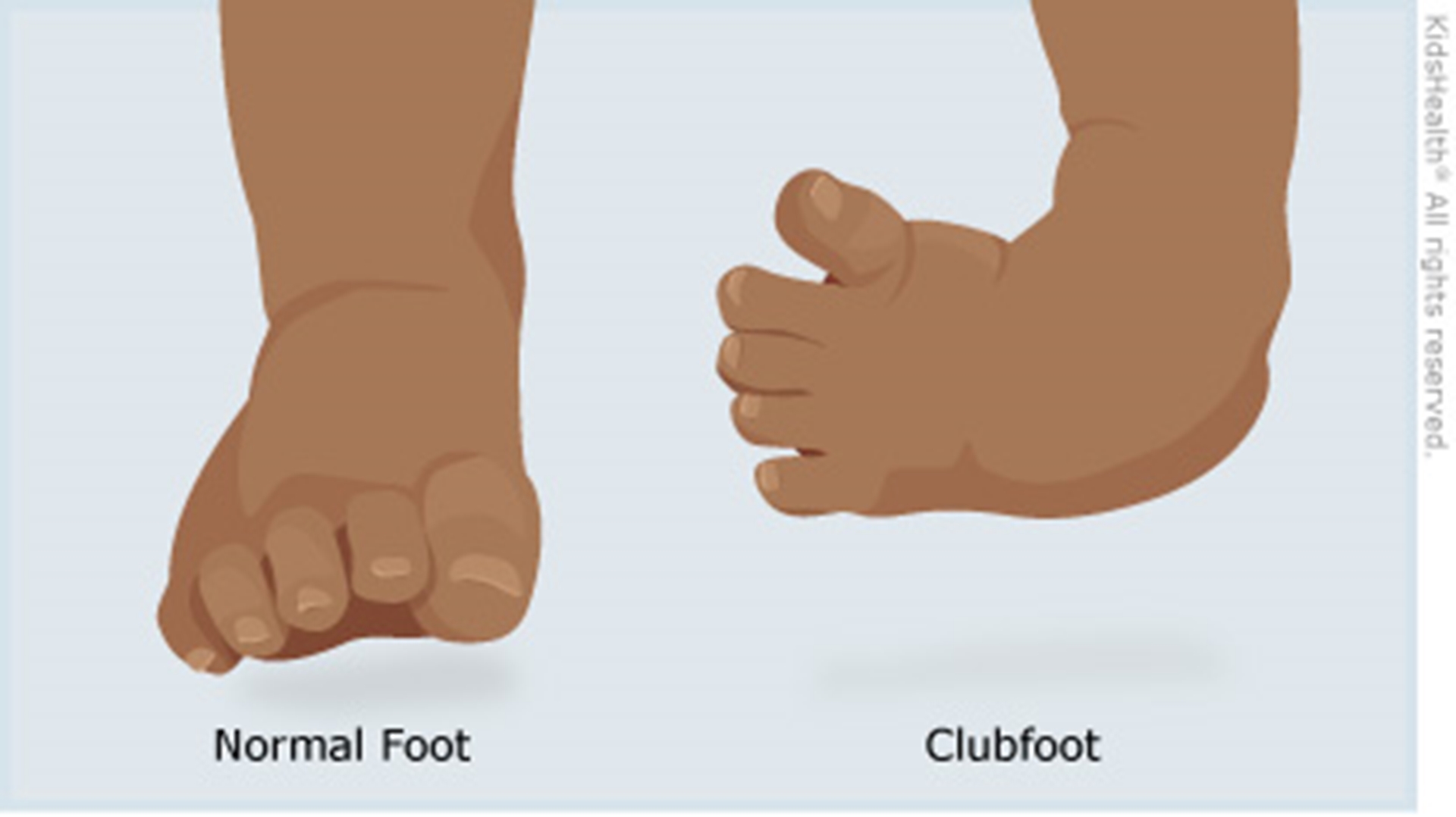 clubfoot_a_enil-main