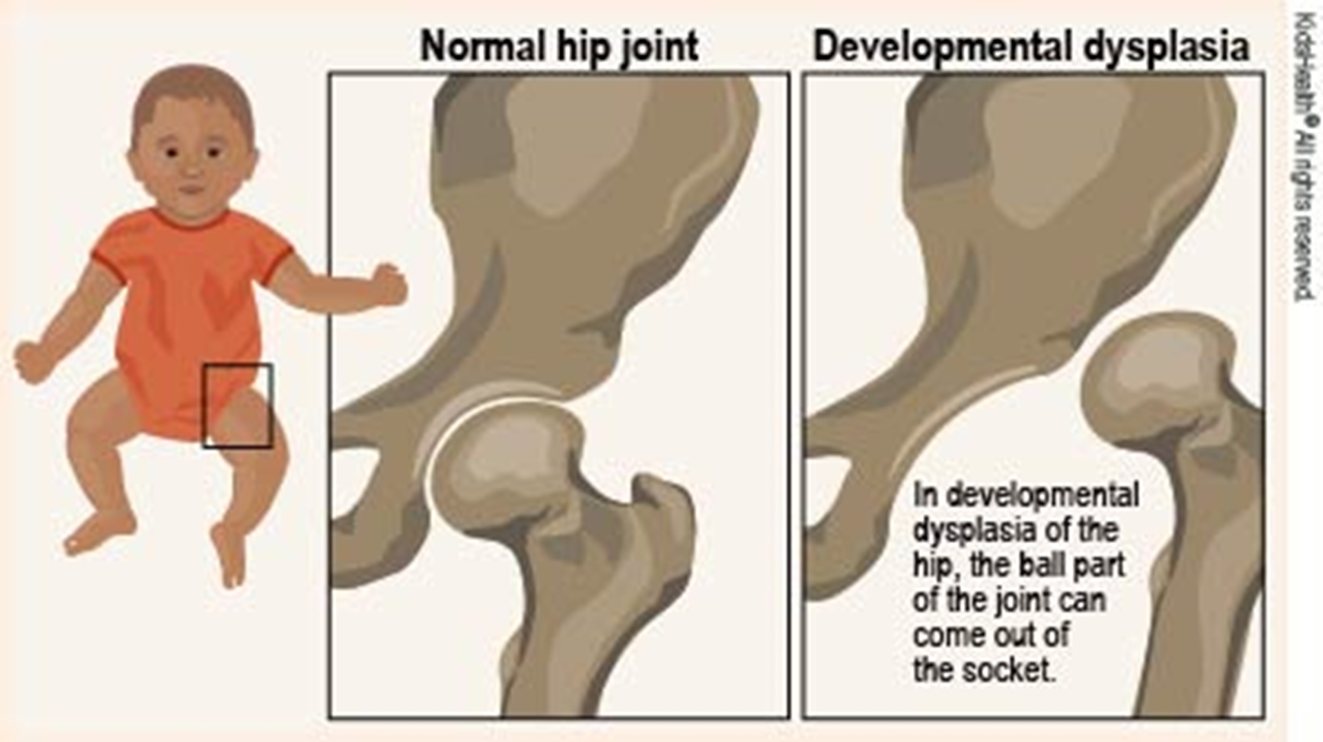 developmentaldyslpasiahip_enil-main