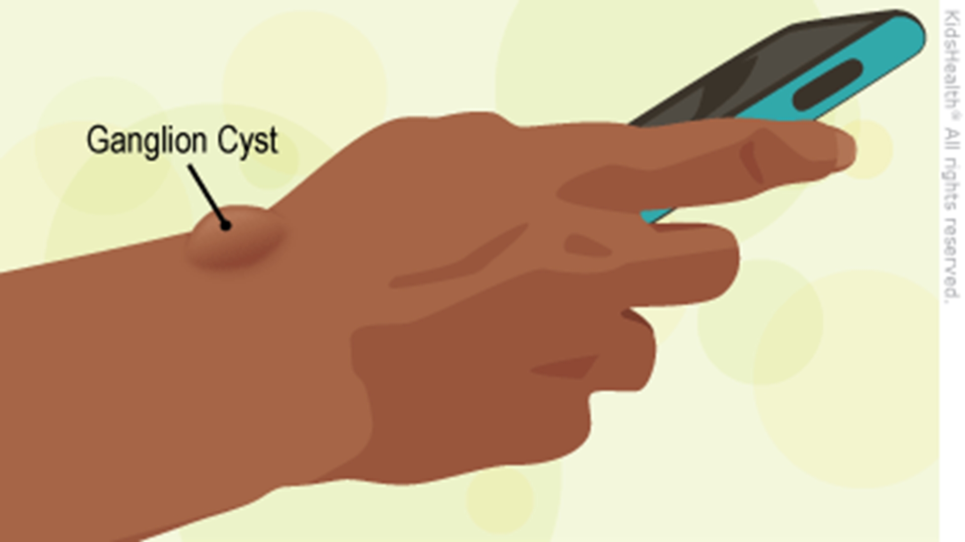 ganglioncystsurface_a_enil-main