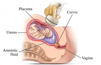 ultrasound-clubfoot
