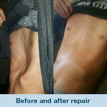 photo-pectus1