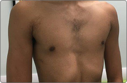 photo-pectus3